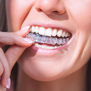 clear aligners