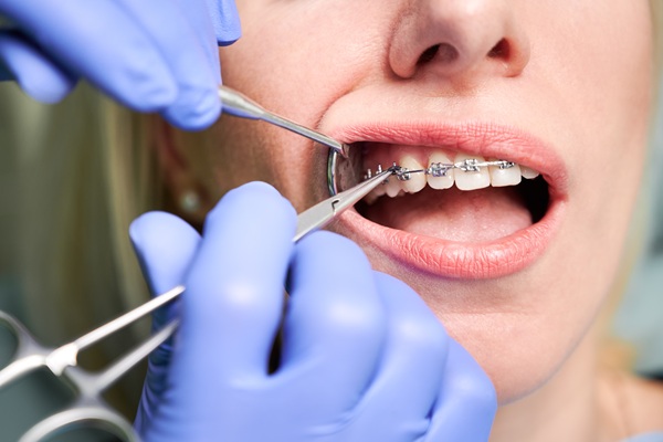 Braces Near Me: Tips To Help Prepare For Treatment