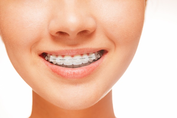 Clear Braces: What Makes A Good Candidate?